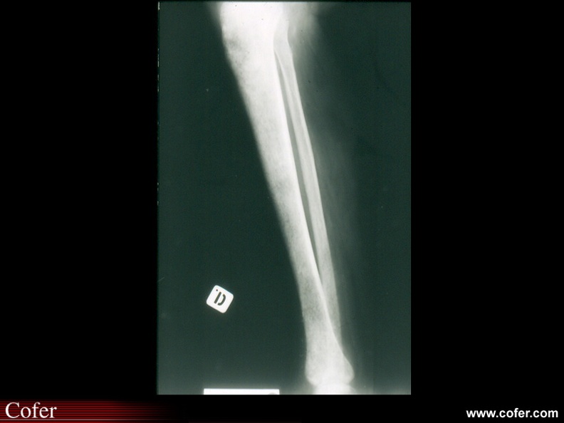 Métastases osseuses : Fémur droit : une métastase à limites nettes surplombe une encoche métastatique du bord interne de la corticale ; fémur gauche : une métastase à bords nets surplombe un aspect vermoulu de la diaphyse. 050302024.jpg