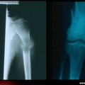 Métastases osseuses : fractures pathologiques