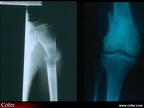 Métastases osseuses : fractures pathologiques