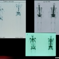 Métastases osseuses:scintigraphie squelettique au cours des métastases osseuses