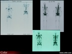 Métastases osseuses:scintigraphie squelettique au cours des métastases osseuses