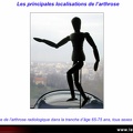 Arthrose digitale : distribution de l’arthrose