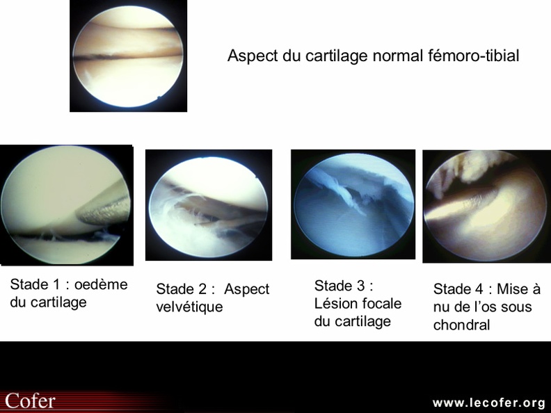 Cartilage : Vue macroscopique : érosions du cartilage