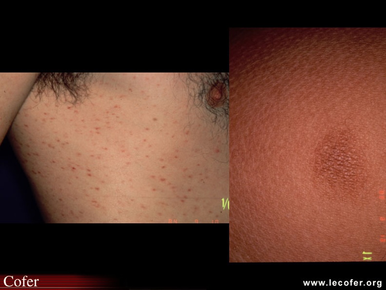 Lésions cutanées de la mastocytose : urticaire pigmentaire, Signe de Darier. 090300012.jpg