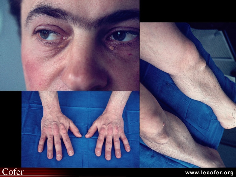 Xanthelasma sous-palpébral, xanthome tubéreux des tendons extenseurs des doigts et des tendons rotuliens. 090300019.jpg