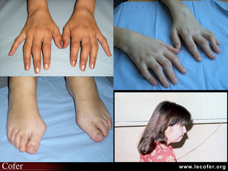 Polyarthrite juvénile facteur rhumatoïde positive : atteinte bilatérale et symétrique des mains (poignets, MCP, IPP) avec évolution progressive vers une subluxation du carpe et doigts en boutonnières (b) ; atteinte de l'avant-pied (c). Le rétrognatisme est la conséquence d'un trouble de croissance de la branche montante du maxillaire. 100001002.jpg
