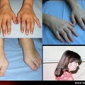 Polyarthrite, polyarthrite rhumatoïde : atteinte des mains des pieds, rétrognathisme, rhumatisme inflammatoire