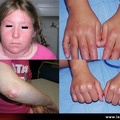 Dermatomyosite juvénile : atteinte cutanée des mains et du visage, calcinose