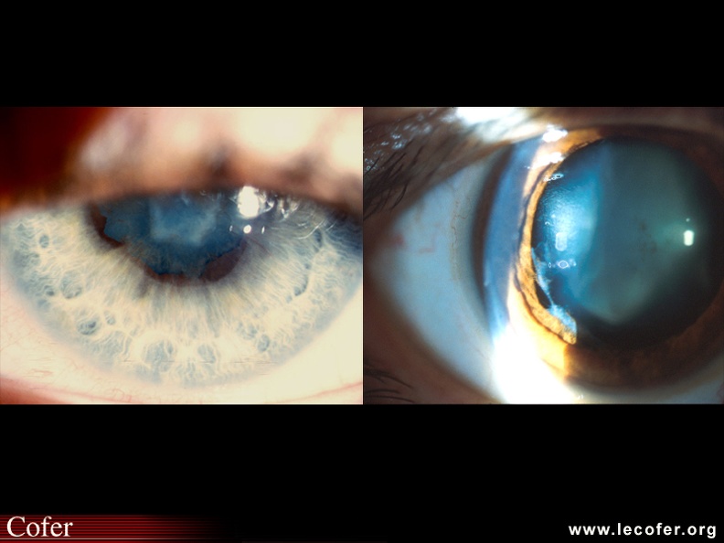 L'atteinte ophtalmologique doit être dépistée par examen à la lampe à fente ; des séquelles sont fréquentes à type de synéchies iridocristalliniennes (photo b) ou de synéchies et cataracte (photo a). 100002013.jpg