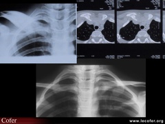 Ostéite chronique récurrente multifocale : atteinte de la clavicule