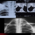 Ostéite chronique récurrente multifocale : atteinte de la clavicule