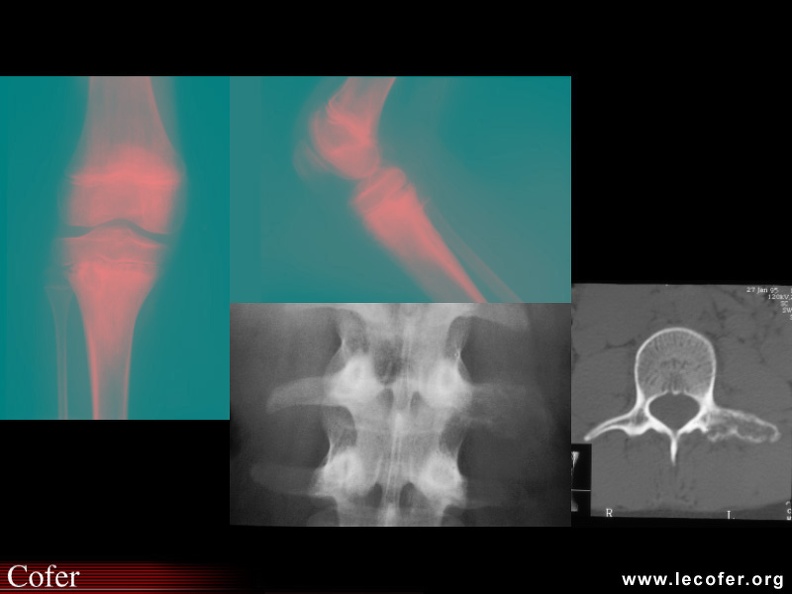 Ostéite chronique récurrente multifocale. Lésion typique métaphysaire tibiale avec zones lytiques entourées de sclérose. Au rachis, lésion lytique de la transverse gauche de L3. Le scanner montre la lyse sans envahissement des parties molles. 100002019.jpg