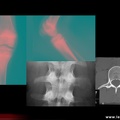 Ostéite chronique récurrente multifocale : lésion lytique tibiale et rachidienne