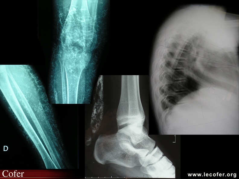 Dermatomyosite : calcinose et déminéralisation du rachis. Pédiatrie. Connectivite