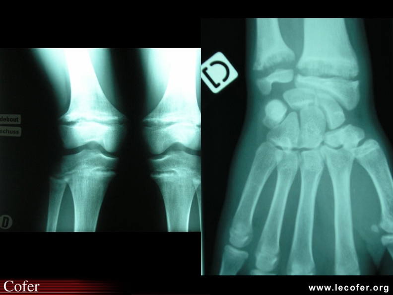 Rachitisme sévère chez une enfant de 11 ans : élargissement et aspect irrégulier des cartilages de conjugaison au niveau des genoux avec incurvation des diaphyses (a) ; atteinte de l'extrémité inférieure des os de l'avant-bras (b) et chapelet costal (c). 100002037.jpg