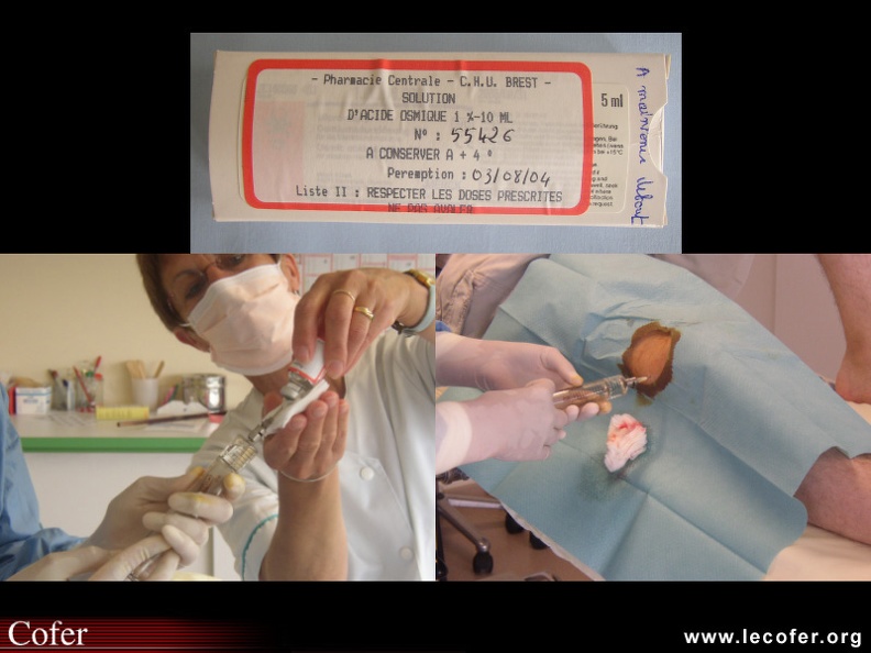 L'acide osmique est, avec les radio-isotopes, un des produits injectables en intra-articulaire pour synoviorthèse (produit dans son flacon, puis son prélèvement, puis son injection). 120001007.jpg