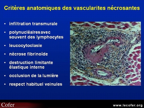 Vascularites, critères anatomo-pathologiques des vascularites nécrosantes