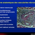 Vascularites, critères anatomo-pathologiques des vascularites nécrosantes