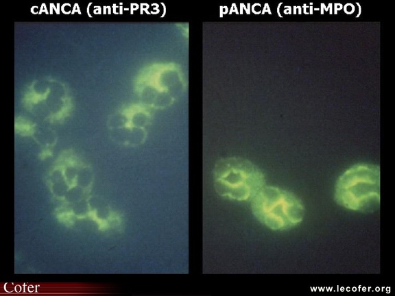 Anticorps anti-cytoplasme des polynucléaires, ANCA