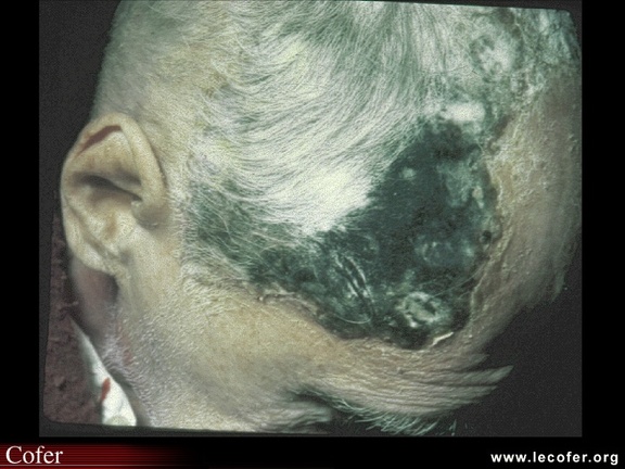 Maladie de Horton : nécrose du scalp