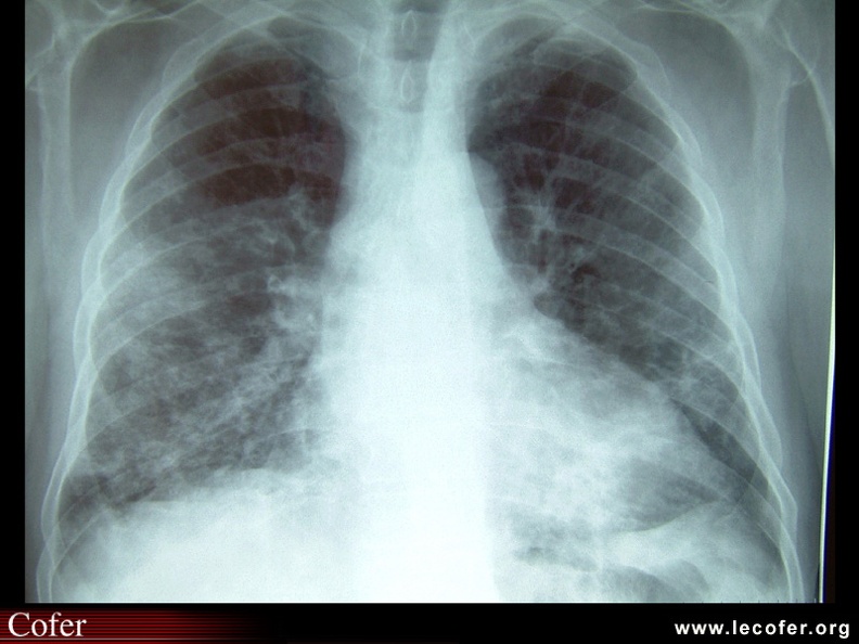 Syndrome de Churg-Strauss. Les infiltrats pulmonaires sont habituellement labiles. Noter la cardiomégalie. L'atteinte cardiaque est une des manifestations les plus sévères du syndrome de Churg-Strauss et représente la première cause de mortalité. 20700030.jpg