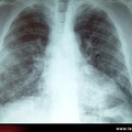 Radiographie. Infiltrat pulmonaire