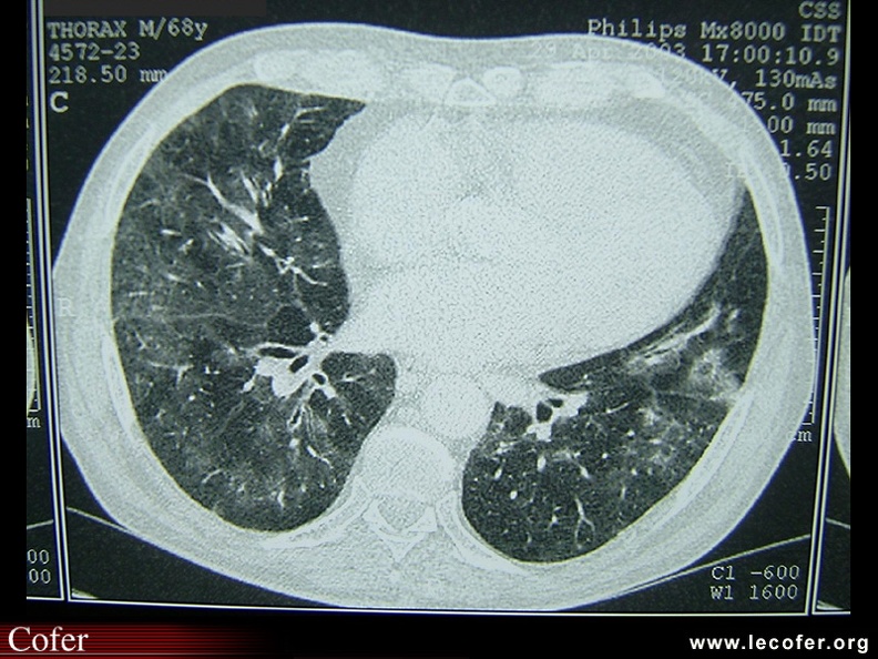 Infiltrat pulmonaire diffus au cours d'un syndrome de Churg-Strauss. 20700031.jpg
