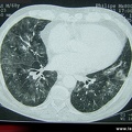 Scanner. Infiltrat pulmonaire