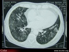 Scanner. Infiltrat pulmonaire