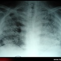 Radiographie. Hémorragie alvéolaire diffuse