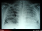 Radiographie. Hémorragie alvéolaire diffuse