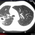 Scanner. Nodule pulmonaire excavé