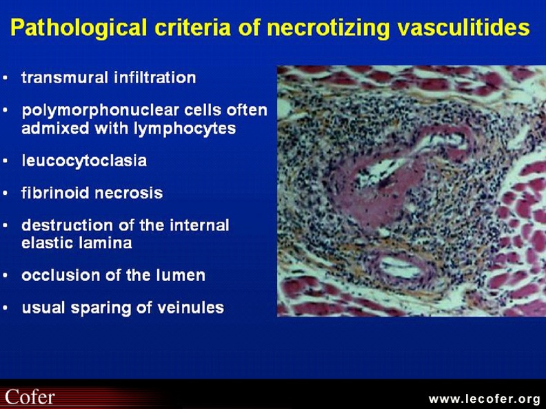 Vascularites, critères anatomo-pathologiques des vascularites nécrosantes