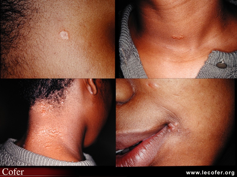 Sarcoïdose : Petites sarcoïdes du visage (tempe et commissure labiale) et du cou. Aspect caractéristique de sarcoïdose. BB005.jpg