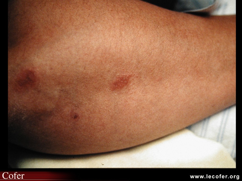 Sarcoïdose : Petites sarcoïdes de la face d'extension du coude. Aspect caractéristique de sarcoïdose. BB006.jpg