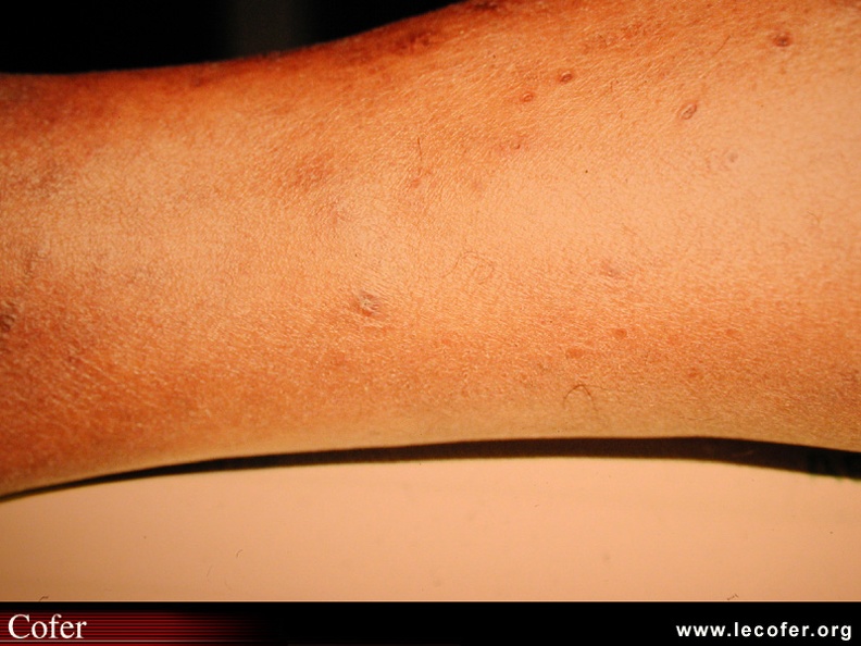 Sarcoïdose : Petites sarcoïdes de la face antérieure de jambe. Aspect caractéristique de sarcoïdose. BB007.jpg