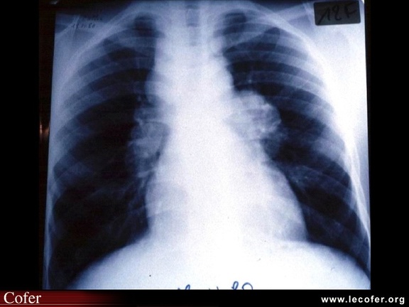 Sarcoïdose pulmonaire