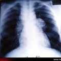 Sarcoïdose pulmonaire