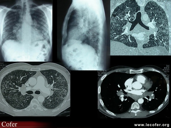 Sarcoïdose pulmonaire