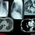 Sarcoïdose pulmonaire