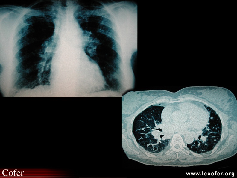 Sarcoïdose pulmonaire