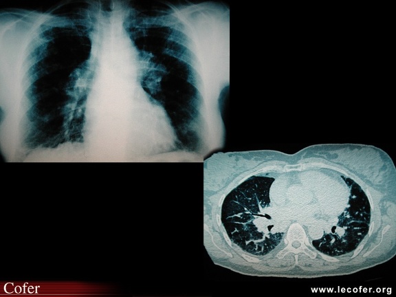 Sarcoïdose pulmonaire