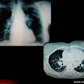 Sarcoïdose pulmonaire