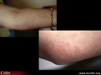 Maladie de Still de l'adulte / maladie de Still : érythème maculo-papuleux de l'avant-bras