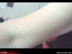 Maladie de Still de l'adulte / maladie de Still : érythème maculo-papuleux de l'avant-bras
