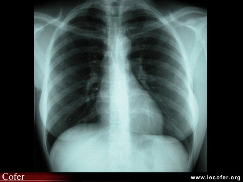 Adénopathies hilaires bilatérales sur la radio de thorax d'un patient souffrant de MSA. SA005.jpg