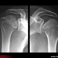 Ostéonécrose aseptique d’épaule : radiographies