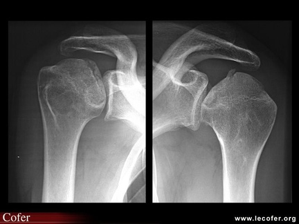 Ostéonécrose aseptique d’épaule : radiographies