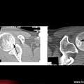 Ostéonécrose aseptique d’épaule : tomodensitométrie