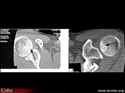 Ostéonécrose aseptique d’épaule : tomodensitométrie